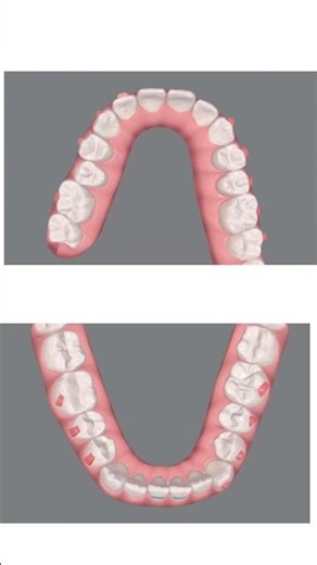 Invisalign journey !!
