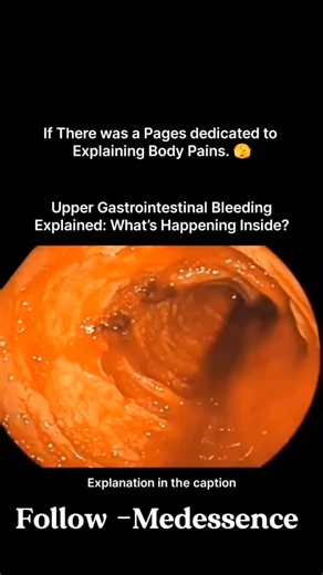 Medessence on Instagram: "Upper gastrointestinal (GI) bleeding is serious bleeding from the esophagus, stomach, or duodenum (first part of the small intestine) and appears as vomiting blood (hematemesis) or black, tarry stools (melena). Common causes include peptic ulcers, gastritis, Mallory-Weiss tears (from retching), varices (swollen veins, often from liver disease), and NSAID use, requiring immediate medical attention, often with endoscopy for diagnosis and treatment like fluid replacement. 