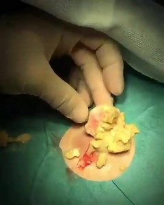 popping up big sebaceous cyst!!! | Doctor's Daily Cases