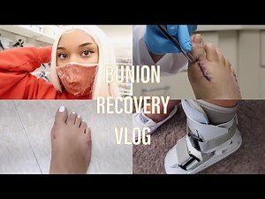 BUNION RECOVERY VLOG #2: Getting Stitches Taken Out | Pain + Swelling | New Boot!