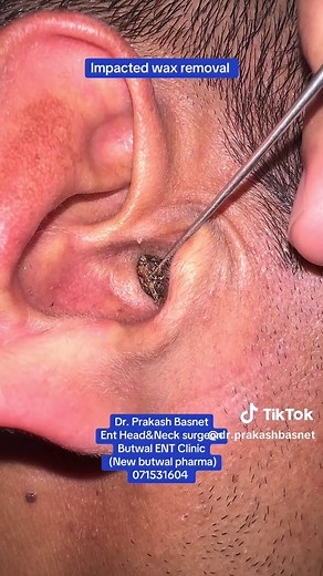 Ear Wax Removal: Impacted Wax Removal by ENT Specialist
