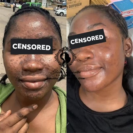 GLOWESSENCE LUXURY SKINCARE | With us, A CLEAR SKIN IS A MUST‼️🌿 Are you still Battling with Severe Acne, Acne scars or Hyperpigmentation? We say Worry no more! Let’s... | Instagram