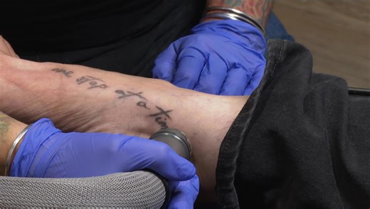 Laser tattoo removal can be painful and pricey, but worth it, says at least 1 recipient