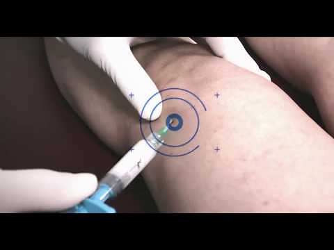 Dr Deakon procedure Q&A on the Cingal Injection for the painful and arthritic knee.