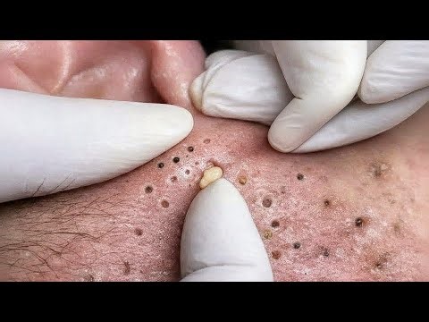 black heads removals | deep cleansing facial | #acnes poping.