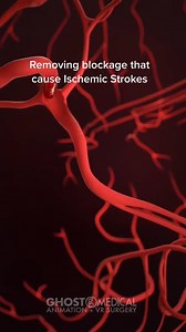 The Stroke Project's MantaRay is designed to remove blockages in the blood vessels in the brain that cause ischemic strokes. It is a small, flexible, catheter-based system that is guided through the blood vessels to the site of the blockage. The device uses a combination of mechanical and suction force to remove the blockage and restore blood flow to the brain. The MantaRay device is minimally invasive and provides an alternative to more traditional, invasive surgical procedures for treating isc
