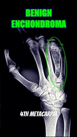 Enchondroma #bones #xray #health