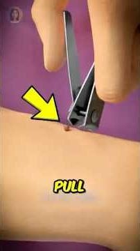 Why You Should NEVER Pull Off a Skin Tag