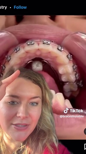 Understanding the Bluegrass Appliance for Open Bite Correction