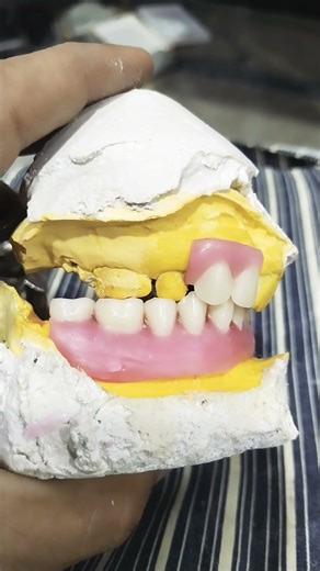 Teeth Arrangement Of Upper Lower Removable Partial Denture 😁😁😁#partialdenture #viralvideo