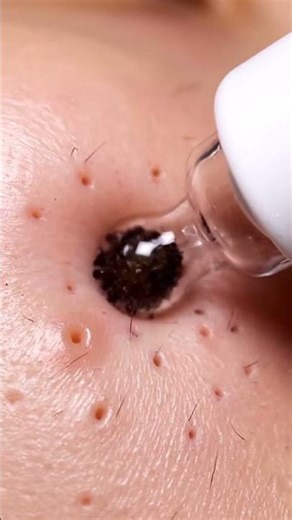 Extreme Blackhead Removal — Oddly Satisfying