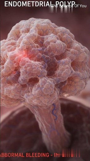 Endometrial Polyps Explained: Symptoms, Causes, & Treatment Options!!!