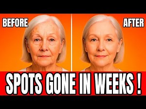How to Remove Age Spots Naturally | Doctor Explains Pigment Spot Treatment