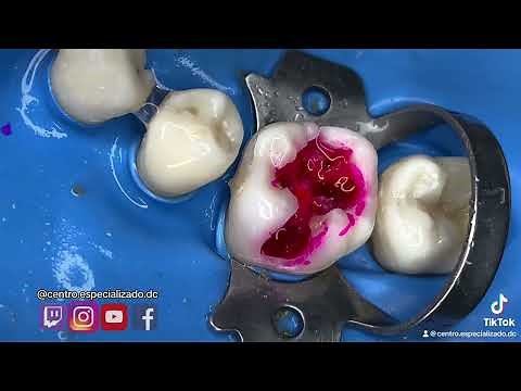 ¡🔥TUTORIAL: Remoción completa de caries dental en una molar (ALTA VELOCIDAD) sin DOLOR 😫🔥!