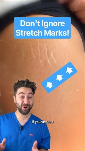 Why stretch marks appear