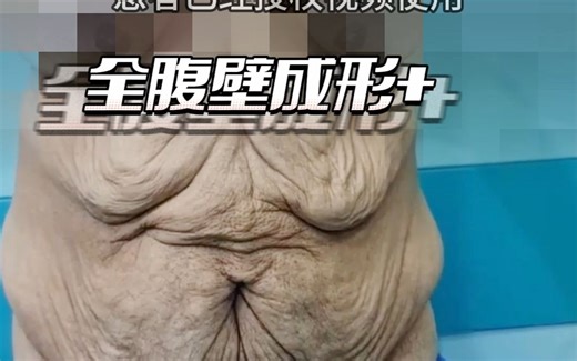 帅哥缩胃手术快速掉重113斤，皮肤松弛耷拉在身上，太痛苦了！
