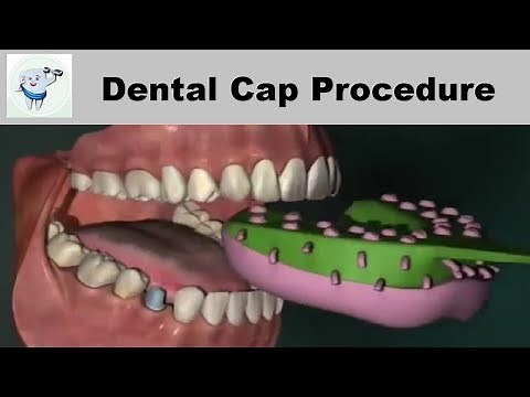 Dental Cap Fixing Procedure