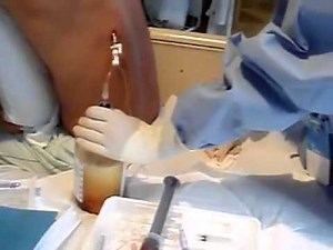 Thoracentesis to remove 1200cc of Pleural Fluid at Harborview