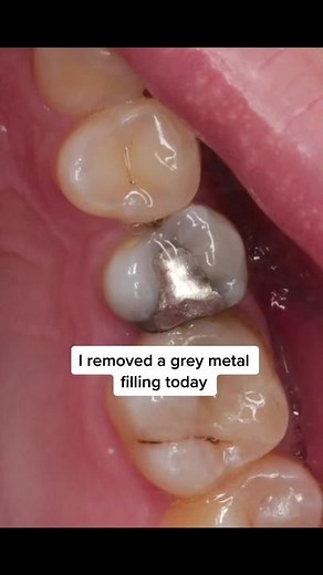 Removing Grey Metal Filling at Seasmiles Dental