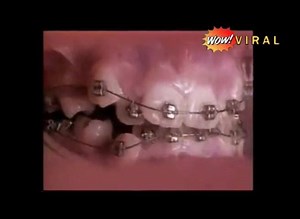 33K views · 326 reactions | Ever have braces? This time-lapse video shows what was going on in your mouth | WowViral Video | Facebook