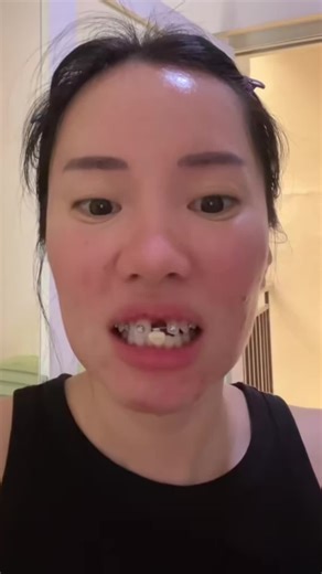 Wait… is that a fake tooth on the braces wire? Dr. Sodhi reacts...In some orthodontic cases, a temporary tooth can be attached to the wire to maintain spacing and improve the look of the smile during treatment. It’s a technique used when a tooth is missing or will be replaced later. #Orthodontics #BracesFacts #OrthodontistReacts #DefineOrthodontics