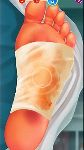 معالجة وخياطة جرح في أسفل القدم Treatment and suturing of a wound on the bottom of the foot #Surgery #عمليات_جراحية #طب #طبيب #متعة_وتعليم | متعة وتعليم