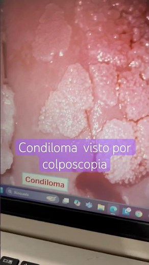 Condiloma acuminado visto en una colposcopia #colposcopia #condiloma #vph #condilomatosis