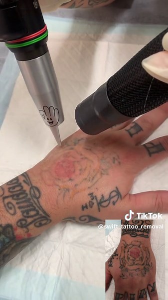 Hand Tattoo Removal: Before and After Treatment
