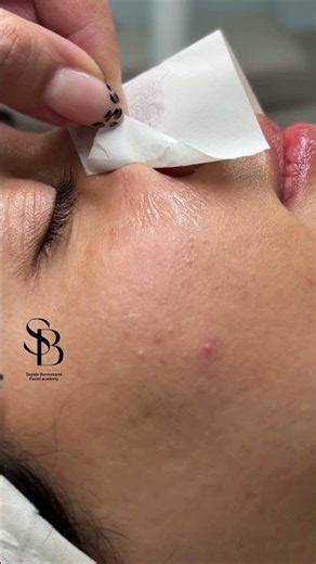 🤯Satisfying Blackhead Removal with Tape 😱 | Deep Pore Cleaning