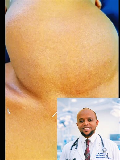 Large Goiter surgery#ethiopian_tik_tok🇪🇹🇪🇹🇪🇹🇪🇹 #habeshatiktok #jimmaabajifar♥️♥️♥️ #drworkneh