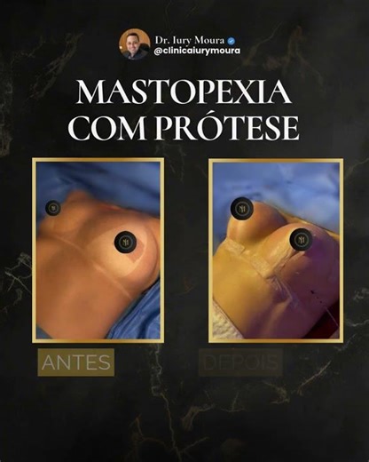 Antes e depois da Mastopexia com Prótese realizada pelo Dr. Iury Moura.