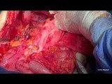 Ovarian Cancer Cytoreductive Surgery. Unedited version. Part II Middle Abdomen. • Video • MEDtube.net