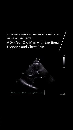 Case Record of the MGH: A 54-Year-Old Man with Exertional Dyspnea and Chest Pain