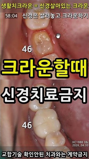 크라운 할때 신경치료금지. 신경을 살려야 하는 이유는? 2026_05_06 샹활치크라운