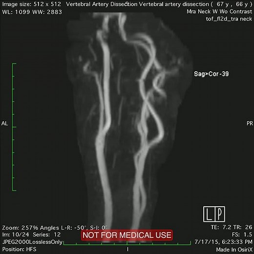 Vertebral Artery Dissection