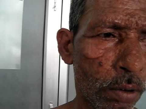 Leonine Facies In Lepromatous leprosy