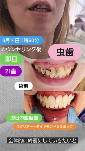 即日多数歯今井です。本日6/14もカウンセリング後、即日セラミックスタートです。虫歯のお悩みを虫歯治療、神経治療、感染根っこ治療、抜歯、歯茎治療をしながら21歯まで進めていきました