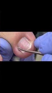 Professional Cleaning of Deformed Toenails #Shorts