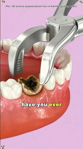 "Tooth Extraction Procedure Explained Step-by-Step#toothextraction #DentalCare #dentalprocedure "