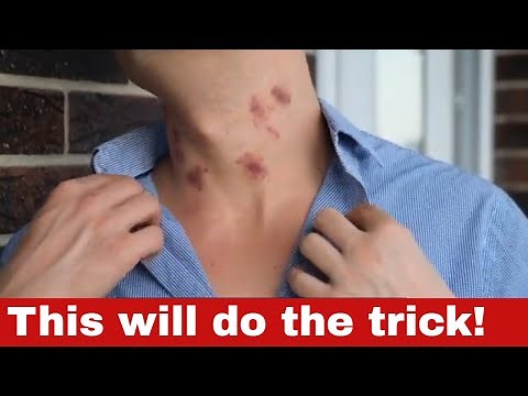 How to Get Rid of Hickeys - 11 Proven Methods to Clear Your Skin Quickly!
