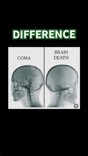 Clinical confusion can cost lives—understand coma vs brain death.✂️👀💯🔝 #youtubeshorts #shortsfeed