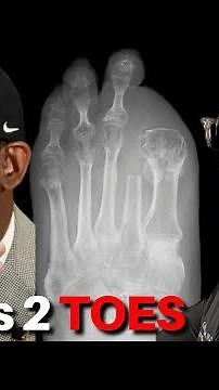 Deion Sanders Reveals Amputated Toes