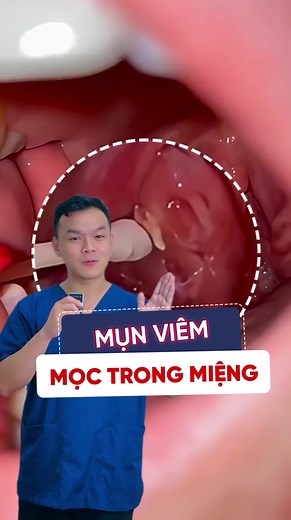 Sỏi Amidan: Nguyên Nhân và Cách Xử Lý Đúng