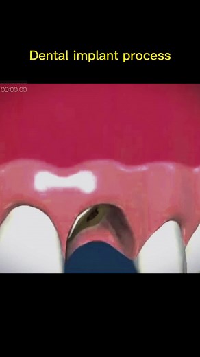 Dental Implant Procedure: Step-by-Step Process Explained