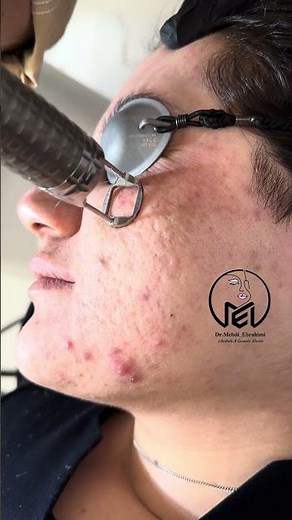 #acnescarremoval with fractional erbium:yag laser by #fotonalaser FS01 lens