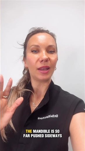 Mandibular Advancement MARPE Expansion