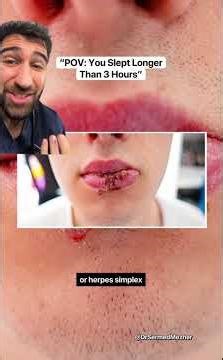 Stevens-Johnson Syndrome? Doctor Explains