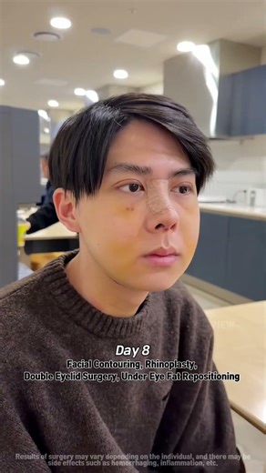 I got plastic surgery in Korea… #kpop #korea #byeonwooseok #parkbogum #bts #fyp