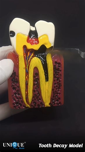 Unique Dents on Instagram: "This Tooth Decay Model clearly shows the difference between healthy and decayed teeth. A healthy tooth has strong enamel, protected dentin, and a healthy pulp. It explains how decay starts on the enamel and spreads to dentin and pulp, leading to pain and infection. It helps patients understand the importance of early treatment. Order now. Contact us: +91 7400121317 #ToothDecayModel #PatientEducation #DentalClinic #OralHealth #UniqueDents #dentalreel #dental #dentist #