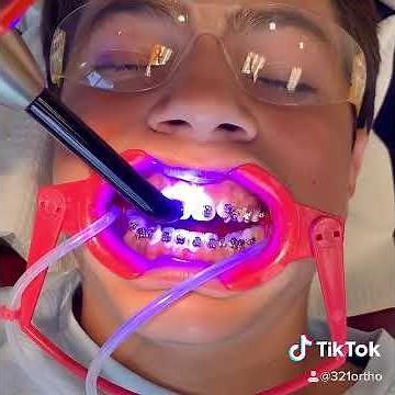 Getting braces put on